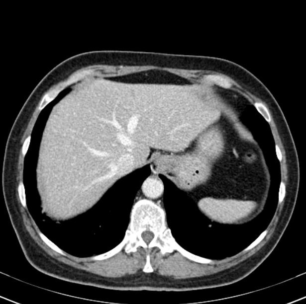 Colon carcinoma with hepatic metastases (Radiopaedia 29477-29961 A 16).jpg