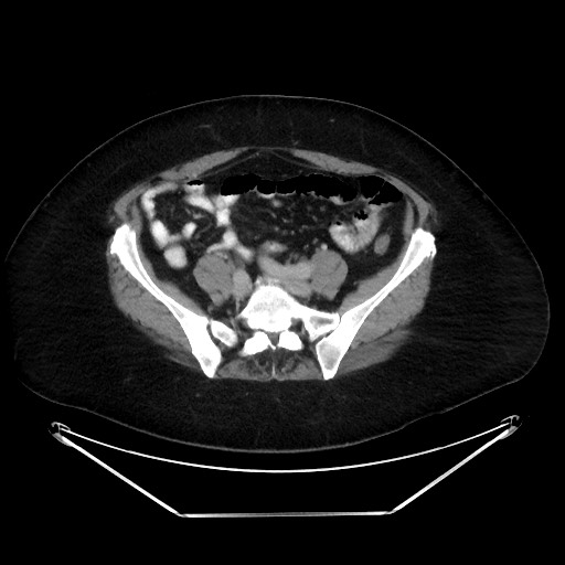 File:Colonic intussusception due to adenocarcinoma (Radiopaedia 86828-102987 A 106).jpg
