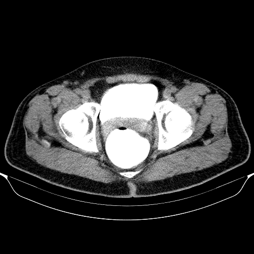 File:Colonic lipoma with colo-colic intussusception (Radiopaedia 58944-66200 Axial C+ rectal 69).jpg
