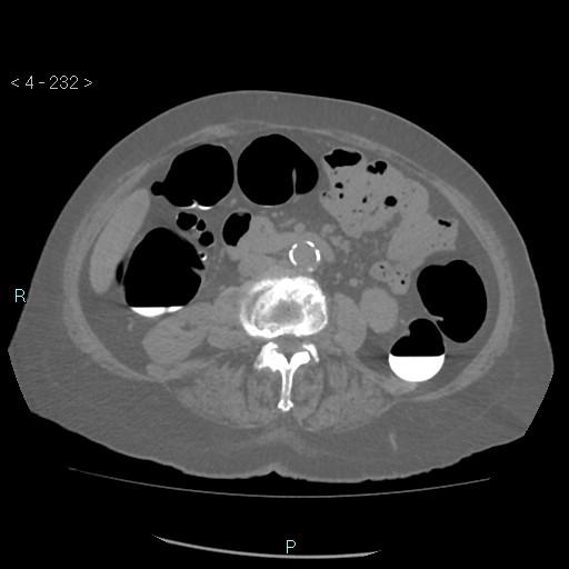 File:Colonic lipomas (Radiopaedia 49137-54244 Axial bone window 104).jpg