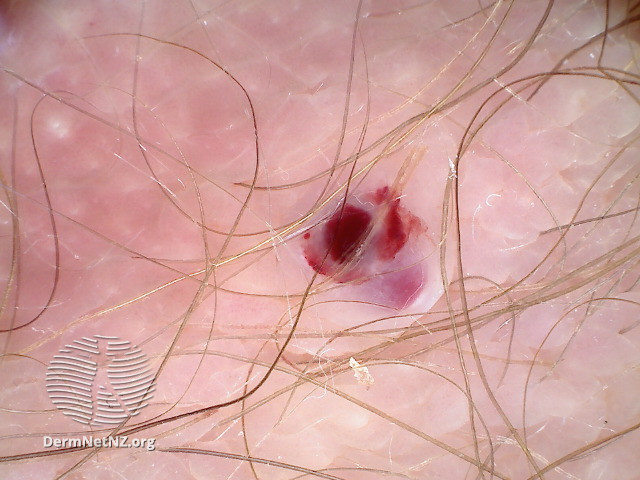 File:Dermoscopy of angiokeratoma of Fordyce on vulva (DermNet NZ angiokeratoma-54).jpg