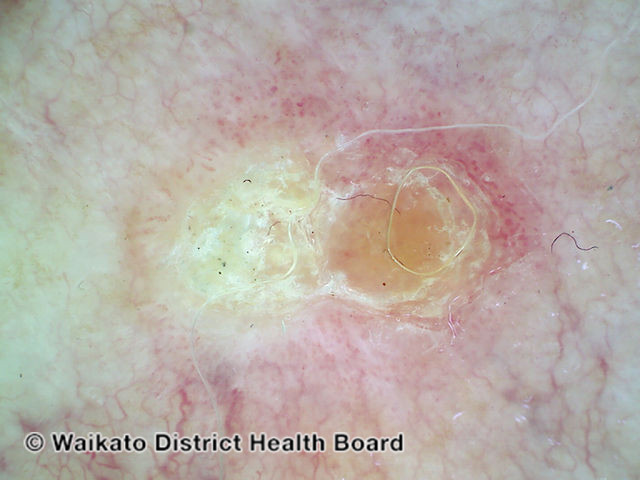 File:Intraepidermal carcinoma, polarised dermoscopy view (DermNet NZ 111488-v2).jpg