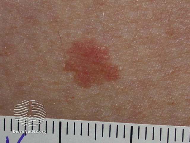 Intraepidermal carcinoma (DermNet NZ lesions-scc-in-situ-2948).jpg
