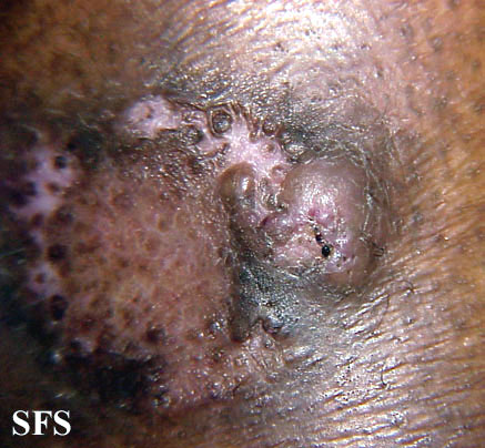 File:Keratoacanthoma (Dermatology Atlas 31).jpg