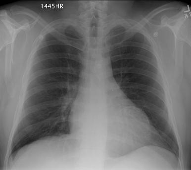 File:Left ventricular aneurysm (Radiopaedia 11571).jpg