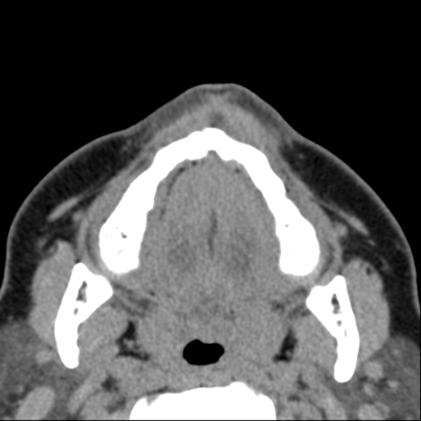 Nasolabial cyst (Radiopaedia 33987-35205 Axial non-contrast 1).jpg