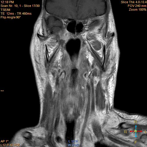 File:Nasopharyngeal carcinoma (Radiopaedia 22375-22403 Coronal T1 C+ 6).jpg