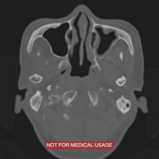 Nasopharyngeal carcinoma recurrence - skull base destruction (Radiopaedia 29107-29490 Axial bone window 96).jpg