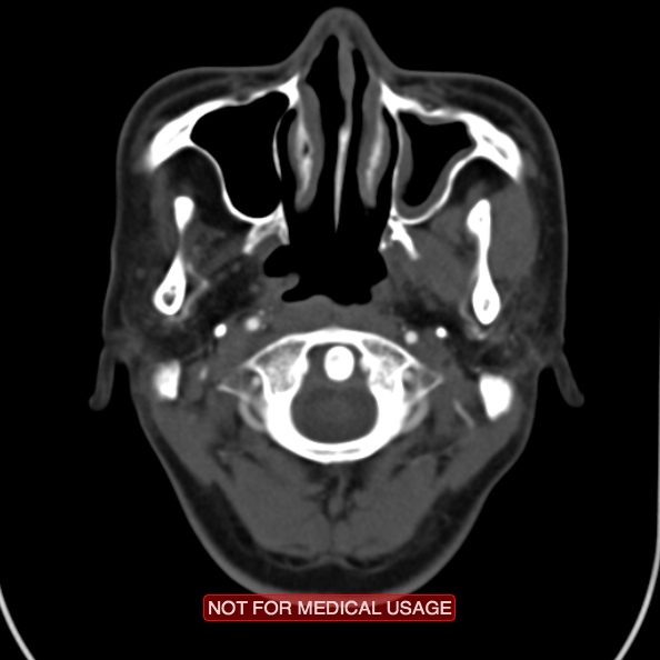 File:Nasopharyngeal carcinoma recurrence - skull base destruction (Radiopaedia 29107-29491 A 11).jpg