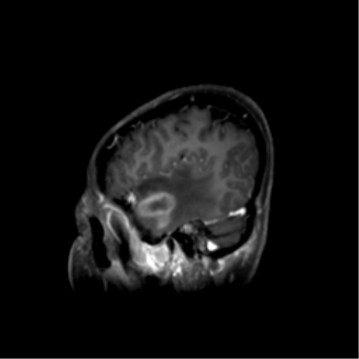 Nasopharyngeal carcinoma with cerebral abscess (Radiopaedia 43018-46274 J 15).png