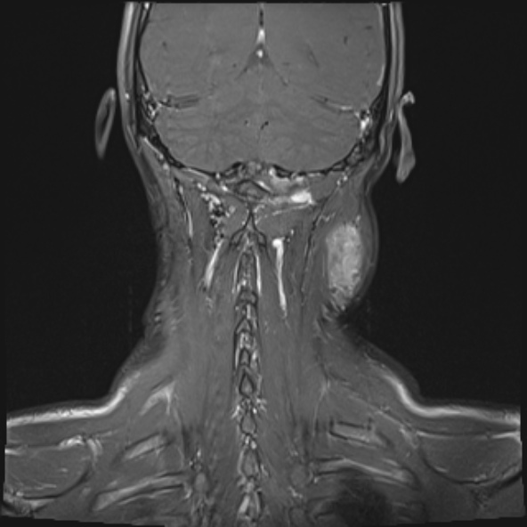 Nasopharyngeal carcinoma with skull base invasion (Radiopaedia 53415-59485 E 3).jpg