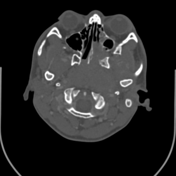 Nasopharyngeal carcinoma with skull base invasion (Radiopaedia 53415-59705 Axial bone window 36).jpg