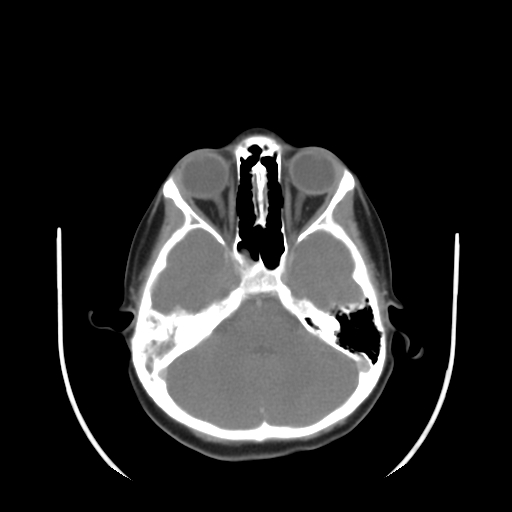 File:Nasopharyngeal rhabdomyosarcoma (Radiopaedia 23417-23491 Axial non-contrast 5).jpg