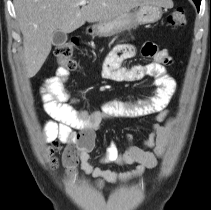 File:Necrotizing pancreatitis with acute necrotic collection (Radiopaedia 14470-14417 C 7).jpg