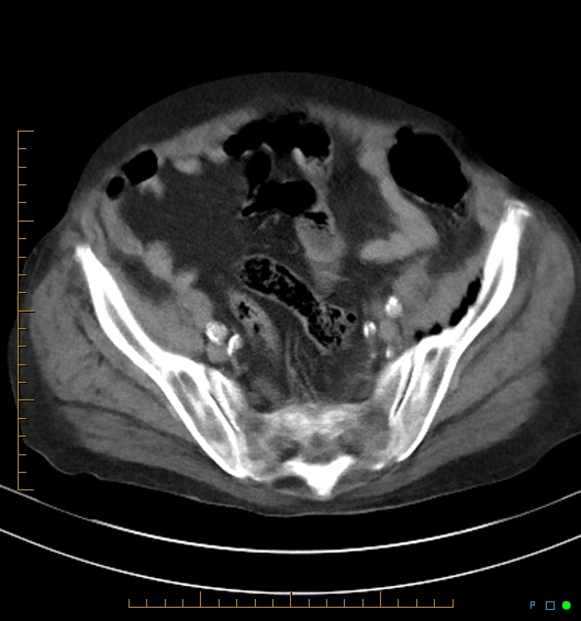 Necrotzing fasciitis due to a perforated adenocarcinoma of the splenic flexure (Radiopaedia 46930-51455 A 50).jpg