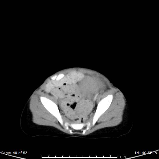 Nephroblastomatosis (Radiopaedia 41934-44935 A 40).jpg