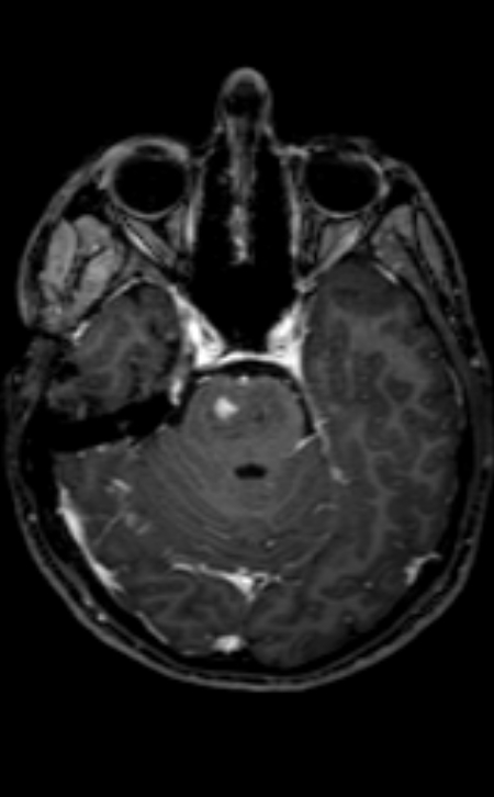 Neuro-Behçet disease (Radiopaedia 90112-107294 Axial T1 C+ 158).jpg