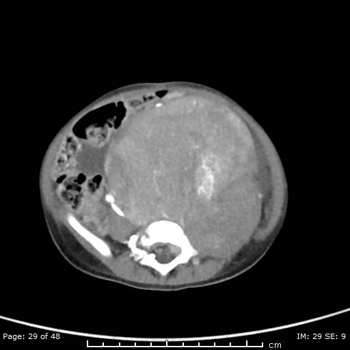 File:Neuroblastoma (Radiopaedia 41472-44355 A 29).jpg