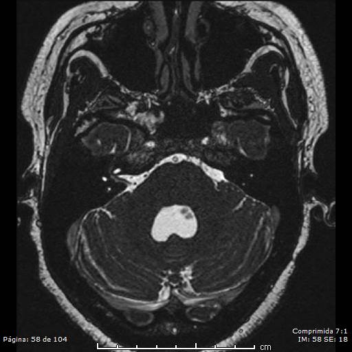 Neurocysticercosis (Radiopaedia 58636-65832 I 58).jpg