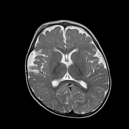 File:Neurofibromatosis type 1 (Radiopaedia 30089-30671 Axial T2 13).jpg