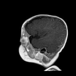 File:Neurofibromatosis type 1 (Radiopaedia 30089-30671 Sagittal T1 C+ 17).jpg