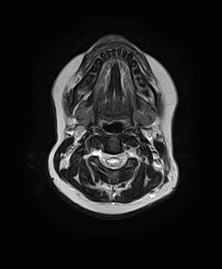 File:Neurofibromatosis type 2 (Radiopaedia 66211-75401 Axial T2 2).jpg