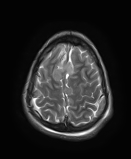 File:Neurofibromatosis type 2 (Radiopaedia 66211-75401 Axial T2 24).jpg