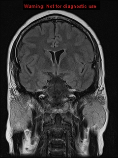 File:Neuroglial cyst (Radiopaedia 10713-11184 Coronal FLAIR 15).jpg