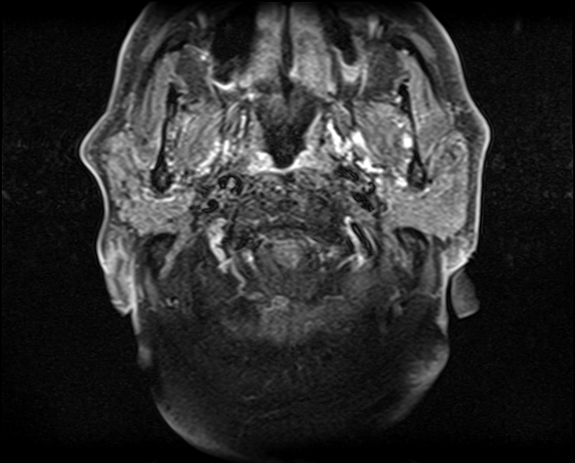File:Non-Hodgkin lymphoma - parotid gland (Radiopaedia 71531-81890 Axial T1 C+ fat sat 17).jpg