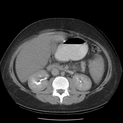 File:Non-Hodgkin lymphoma involving pelvis (Radiopaedia 21281-21197 B 32).jpg