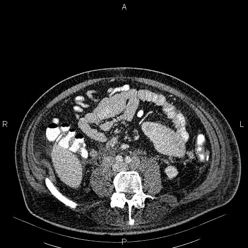 File:Non Hodgkin lymphoma in a patient with ankylosing spondylitis (Radiopaedia 84323-99621 B 45).jpg