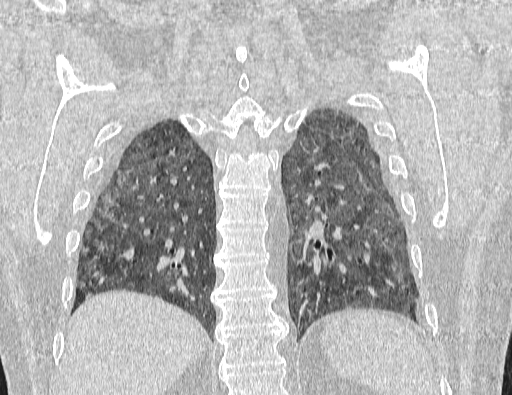 Non specific interstitial pneumonia (NSIP) (Radiopaedia 89725-106798 Coronal lung window 57).jpg