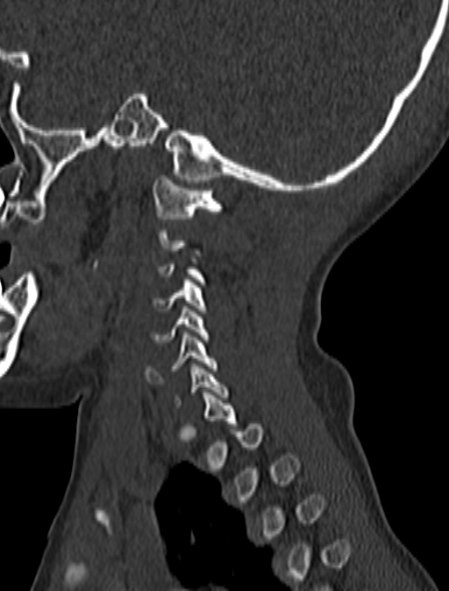 File:Normal CT cervical spine - pediatric (Radiopaedia 52549-58462 Sagittal bone window 29).jpg