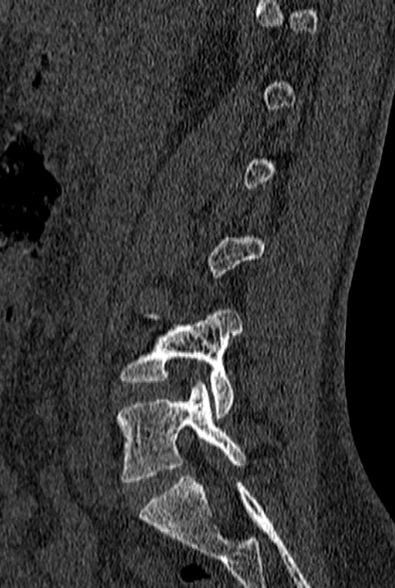 File:Normal CT lumbar spine (Radiopaedia 53981-60118 Sagittal bone window 30).jpg