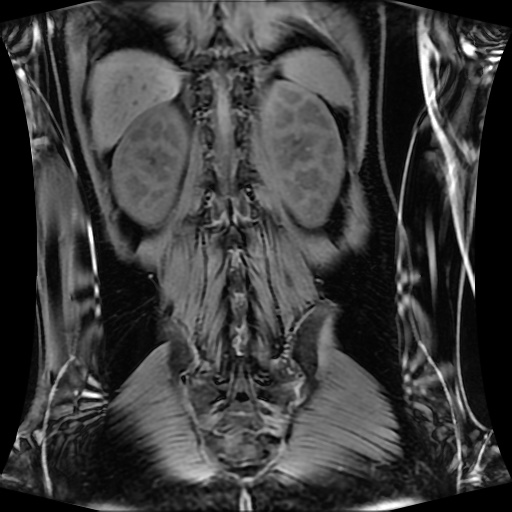 Normal MRI abdomen in pregnancy (Radiopaedia 88001-104541 M 110).jpg
