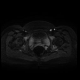 Normal MRI abdomen in pregnancy (Radiopaedia 88005-104548 Axial DWI 47).jpg