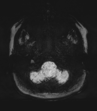 Normal MRI internal auditory canal (Radiopaedia 41613-44525 Axial SWI MIP 7).png