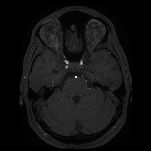 Normal brain MRA (Radiopaedia 41046-43793 Axial MRA 69).png