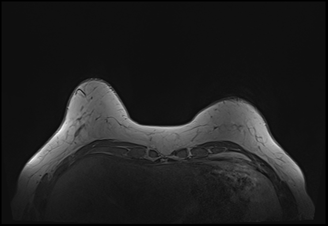 File:Normal breast MRI - dense breasts (Radiopaedia 80454-93850 Axial T1 37).jpg