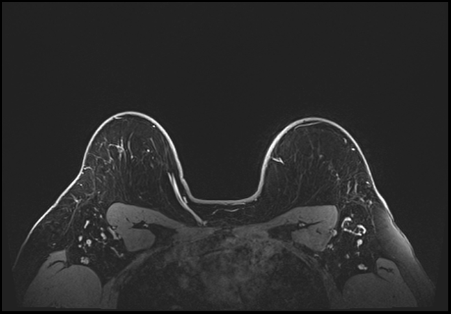 Normal breast MRI - dense breasts (Radiopaedia 80454-93850 C 187).jpg
