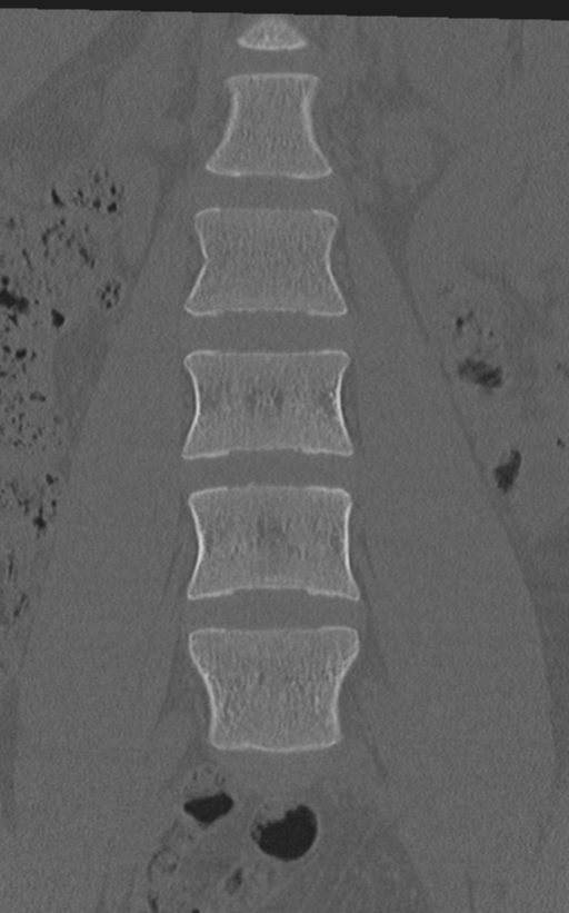 Normal lumbar spine CT (Radiopaedia 46533-50986 Coronal bone window 26).png