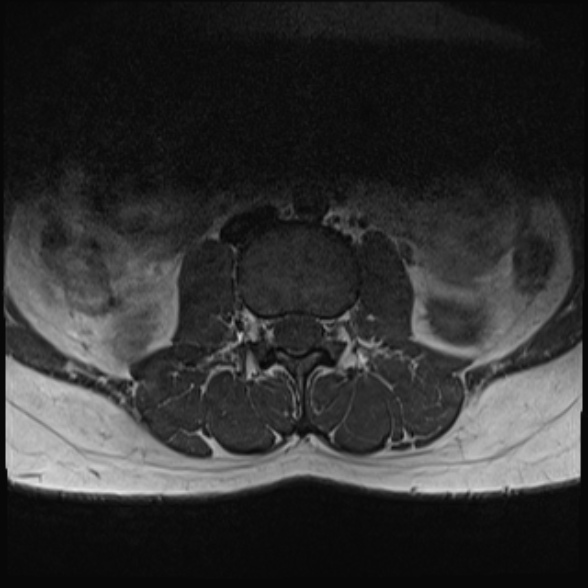 File:Normal lumbar spine MRI- 3 T (Radiopaedia 53280-59250 Axial 6).jpg