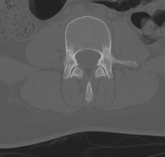 File:Normal lumbosacral CT (Radiopaedia 37923-39867 Axial bone window 60).png