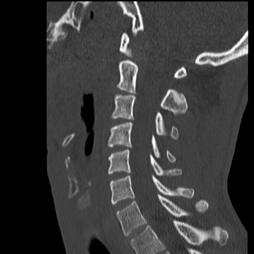 File:Normal trauma cervical spine (Radiopaedia 41017-43760 Sagittal bone window 27).png
