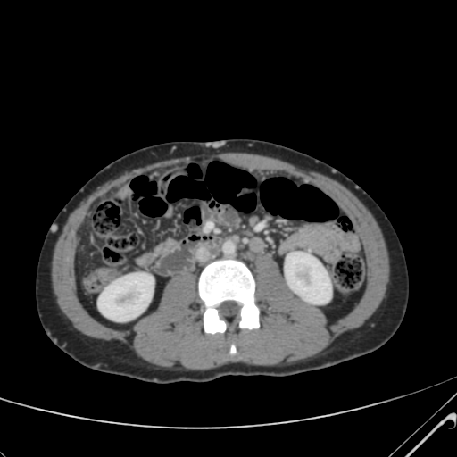 File:Nutmeg liver- Budd-Chiari syndrome (Radiopaedia 46234-50635 B 34).png