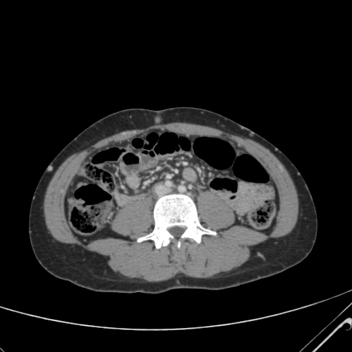 File:Nutmeg liver- Budd-Chiari syndrome (Radiopaedia 46234-50635 B 41).png