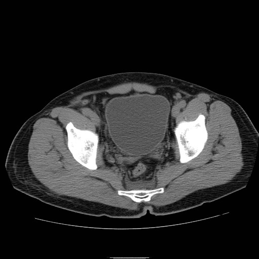 File:Obstructed kidney with perinephric urinoma (Radiopaedia 26889-27066 Axial non-contrast 60).jpg
