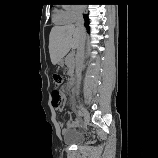 File:Obstructed kidney with perinephric urinoma (Radiopaedia 26889-27066 B 25).jpg
