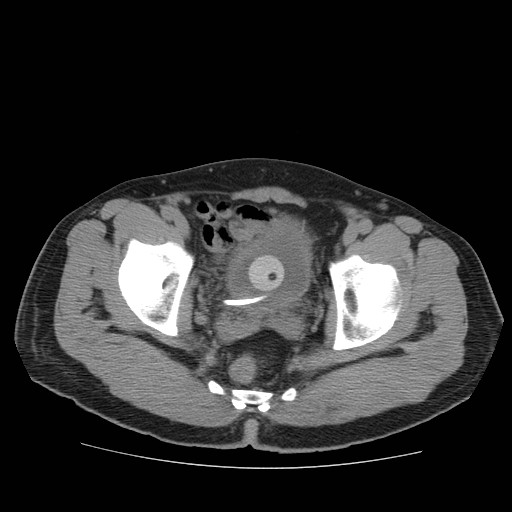 File:Obstructed kidney with perinephric urinoma (Radiopaedia 26889-27067 Axial non-contrast 49).jpg