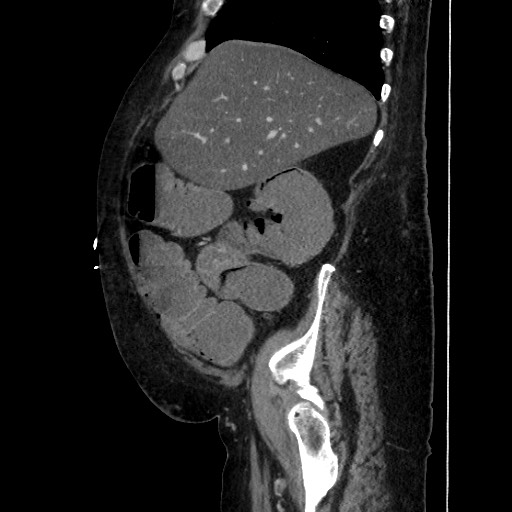 Obstructive colonic diverticular stricture (Radiopaedia 81085-94675 C 68).jpg